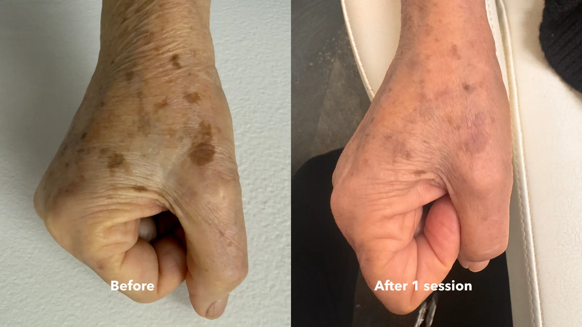 Before and after Melasma & Pigmentation treatment at Get Glowing MedSpa — faded sun spots on the hand after one session