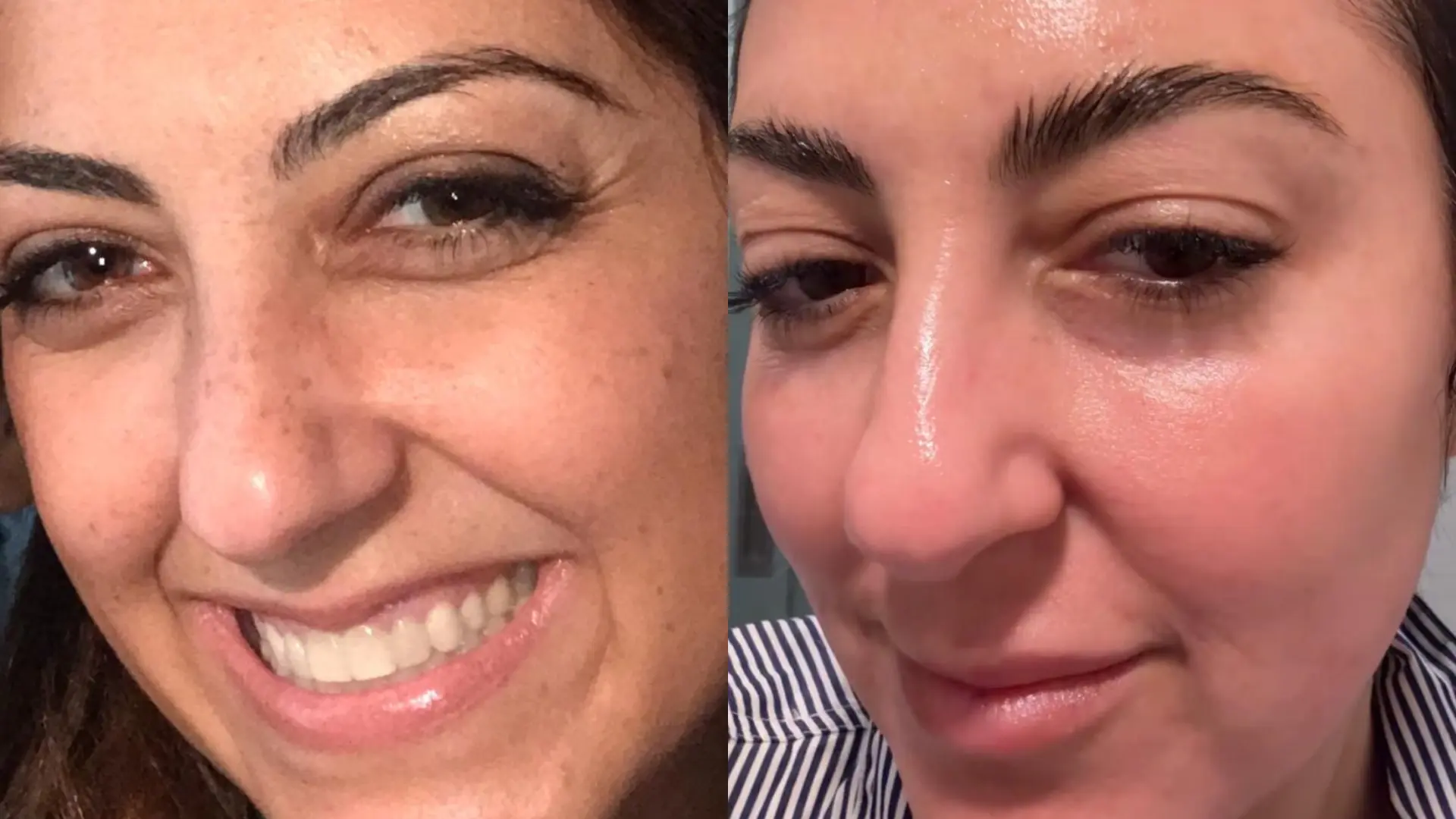 Before and after GlowUp Duo at Get Glowing MedSpa — brighter, more even skin tone and reduced redness
