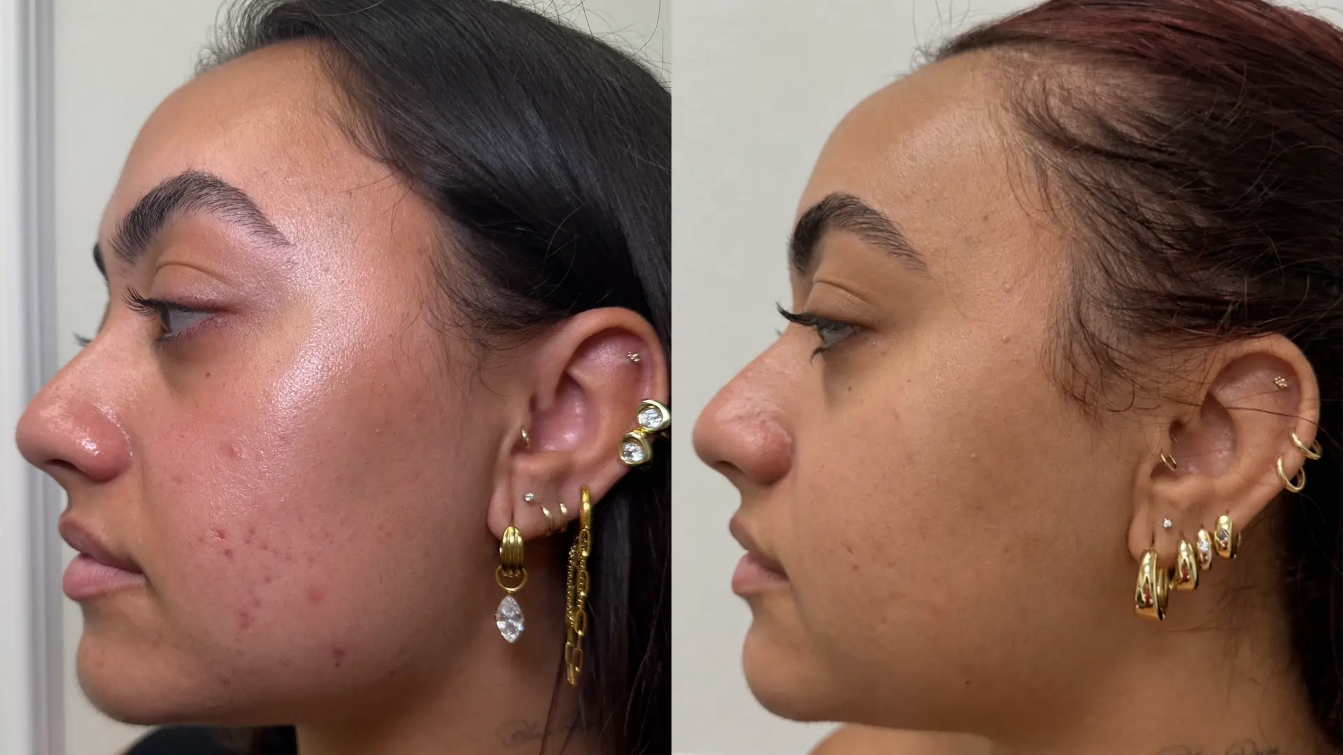 Before and after GlowUp Duo at Get Glowing MedSpa — refined pores and smoother cheek texture