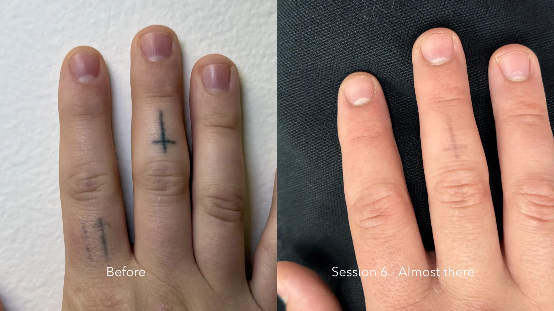 Before and after tattoo removal at Get Glowing MedSpa — small cross finger tattoos faded after 6 sessions