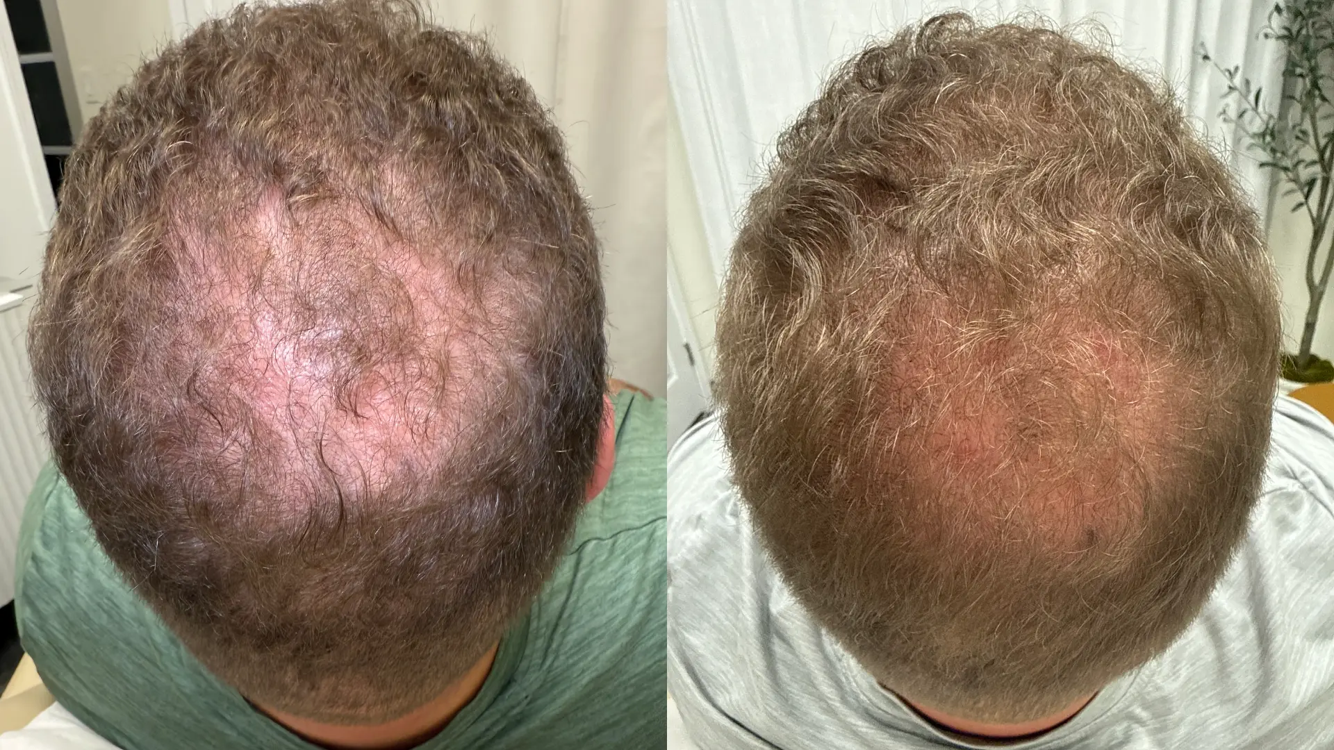 Before and after PRP hair restoration at Get Glowing MedSpa — increased density at the crown