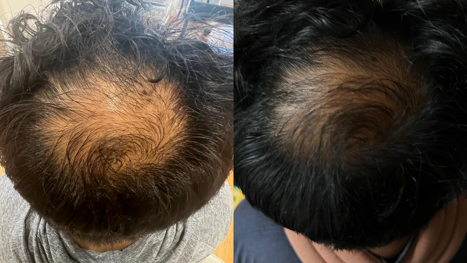 Before and after PRP hair restoration at Get Glowing MedSpa — thicker, denser growth across the crown