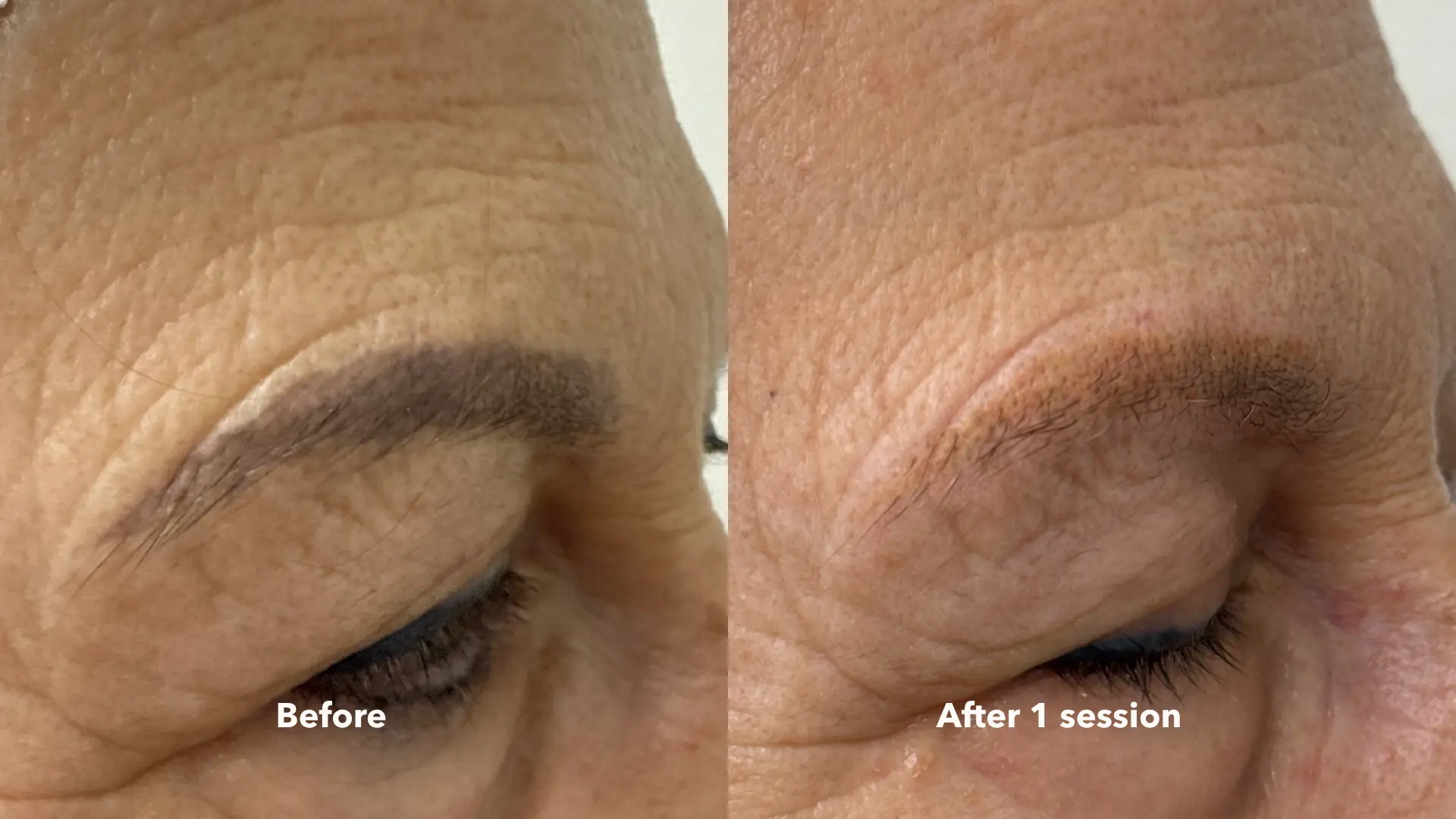 Before and after Cosmetic Brow Removal at Get Glowing MedSpa — continued brow pigment fading
