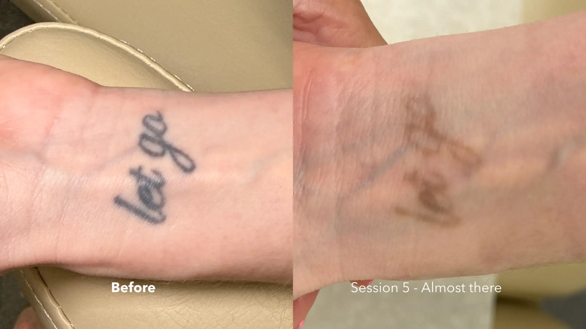 Before and after tattoo removal at Get Glowing MedSpa — wrist lettering tattoo faded after 5 sessions