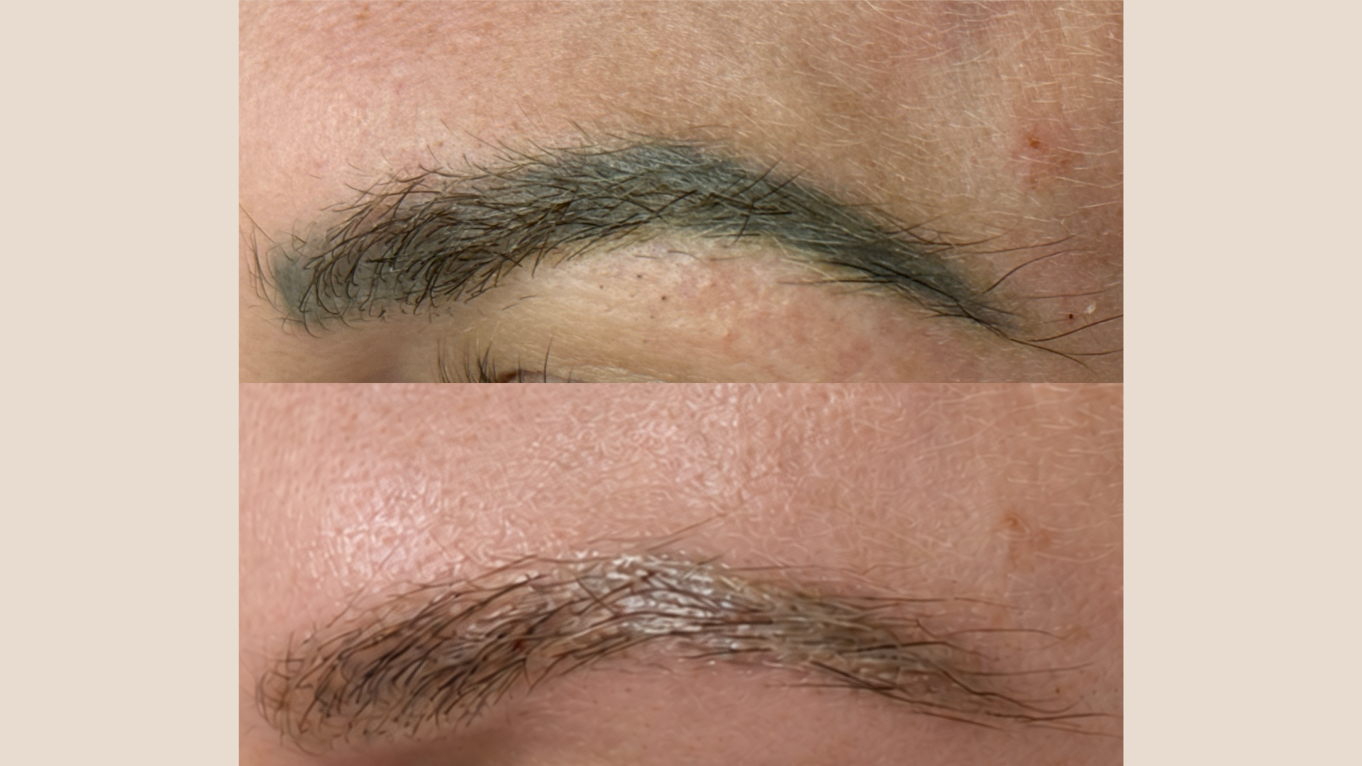 Before and after Cosmetic Brow Removal at Get Glowing MedSpa — permanent makeup shadow along the brow line largely cleared