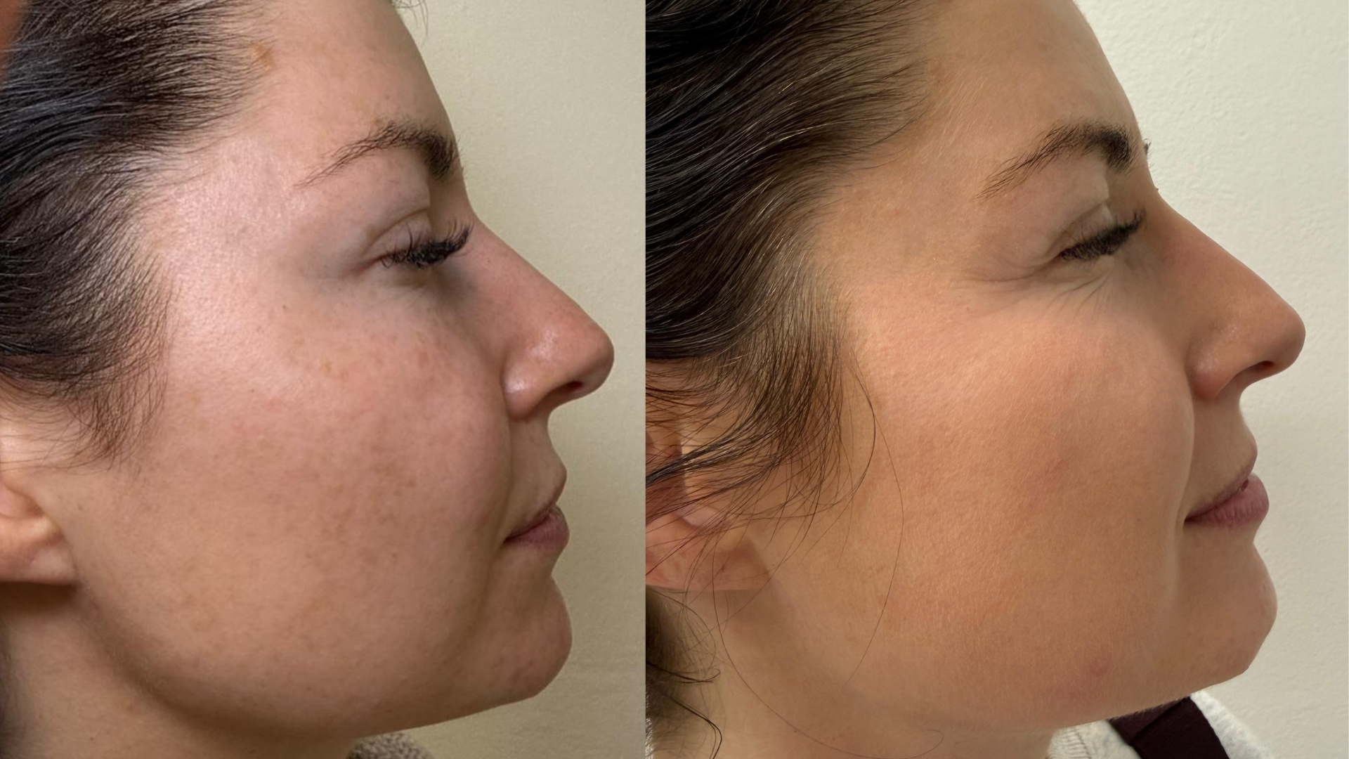 Before and after Melasma & Pigmentation treatment at Get Glowing MedSpa — brighter, more even facial profile