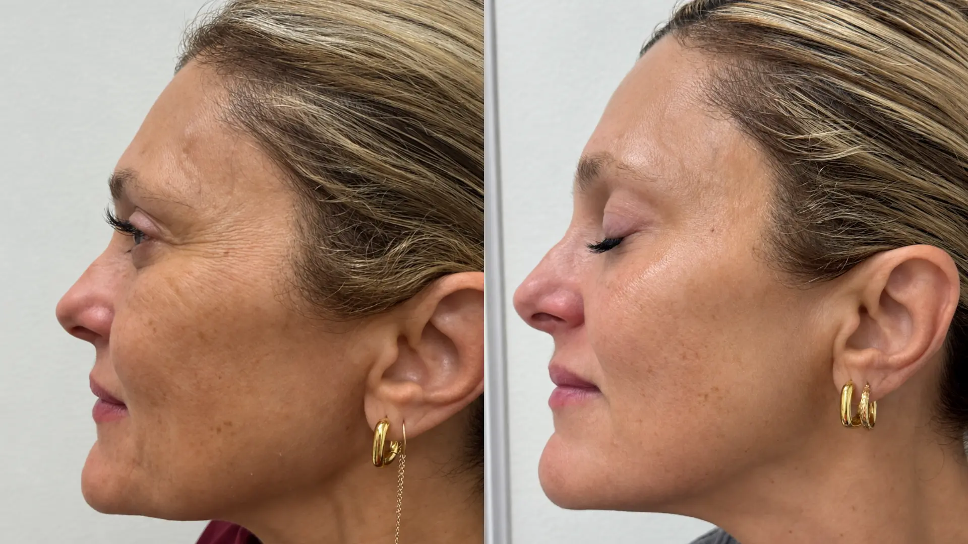 Before and after PRX Glow treatment at Get Glowing MedSpa — smoother, firmer profile with reduced fine lines