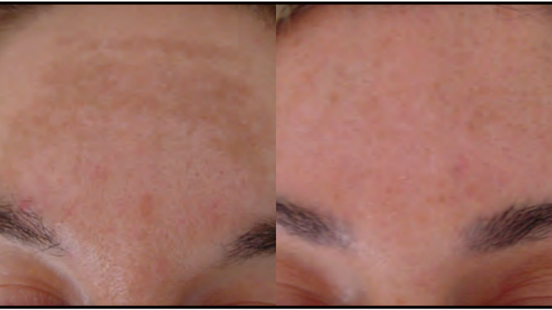 Before and after Melasma & Pigmentation treatment at Get Glowing MedSpa — more even forehead skin tone
