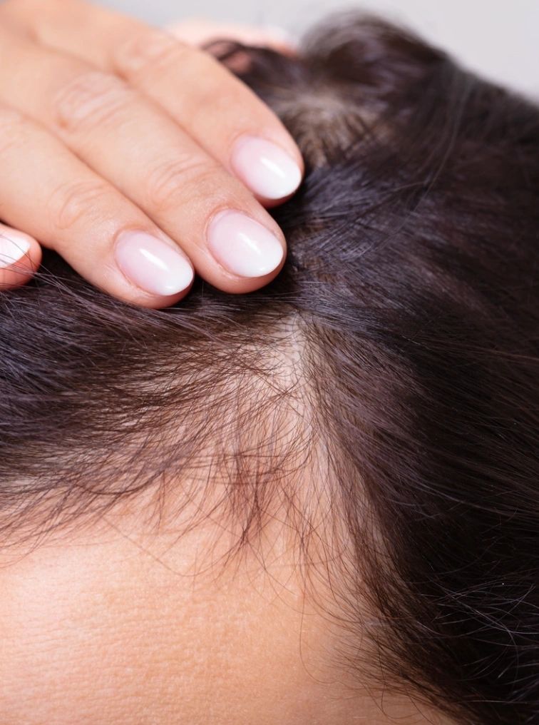 PRP vs Exosomes for Hair Restoration: Which Treatment Is Right fo