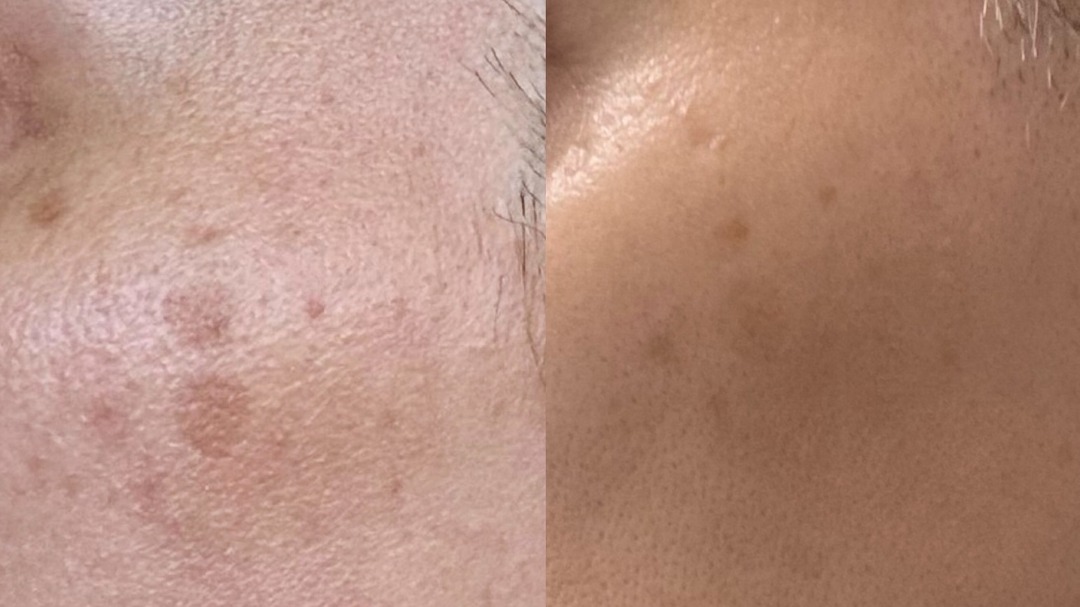 Before and after Melasma & Pigmentation treatment at Get Glowing MedSpa — clearer cheek with reduced discoloration