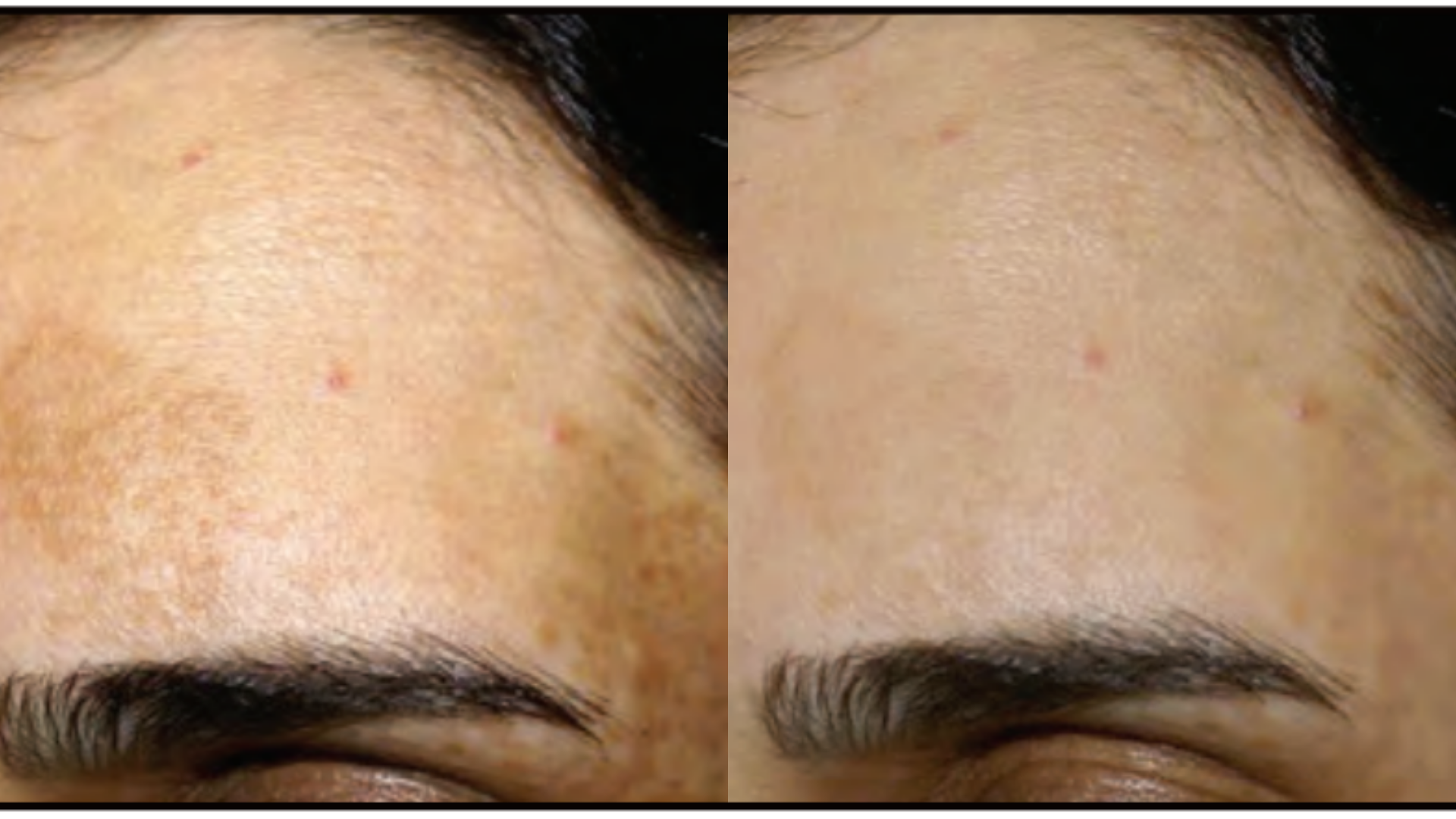 Before and after Melasma & Pigmentation treatment at Get Glowing MedSpa — visibly faded pigmentation on the forehead