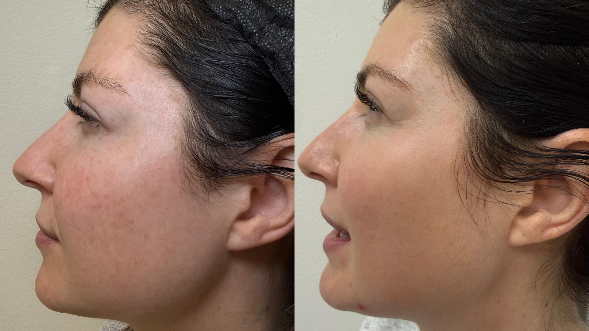 Before and after Melasma & Pigmentation treatment at Get Glowing MedSpa — smoother, more radiant skin tone