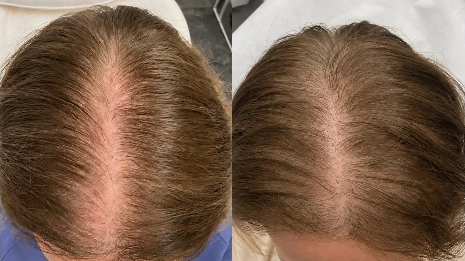 Before and after PRP hair restoration at Get Glowing MedSpa — fuller hair coverage through the crown part line
