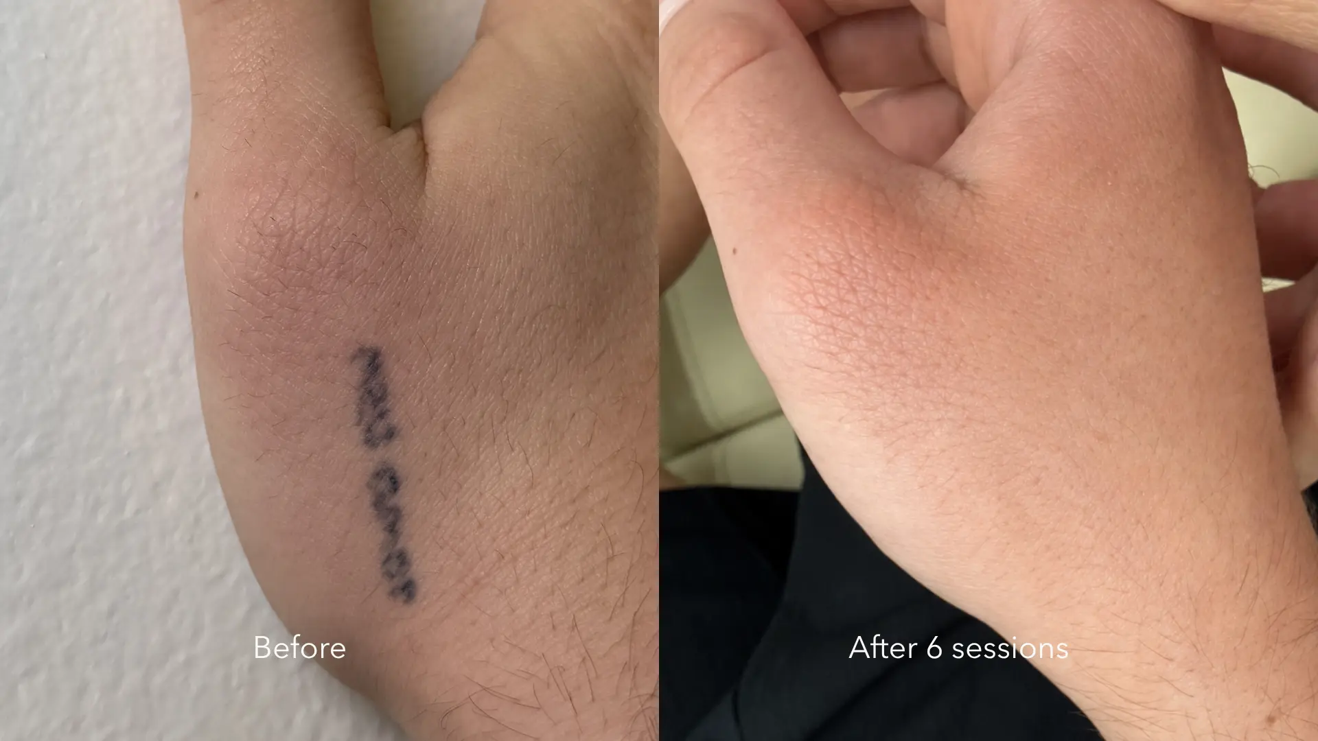 Before and after tattoo removal at Get Glowing MedSpa — hand/wrist tattoo faded after 6 sessions
