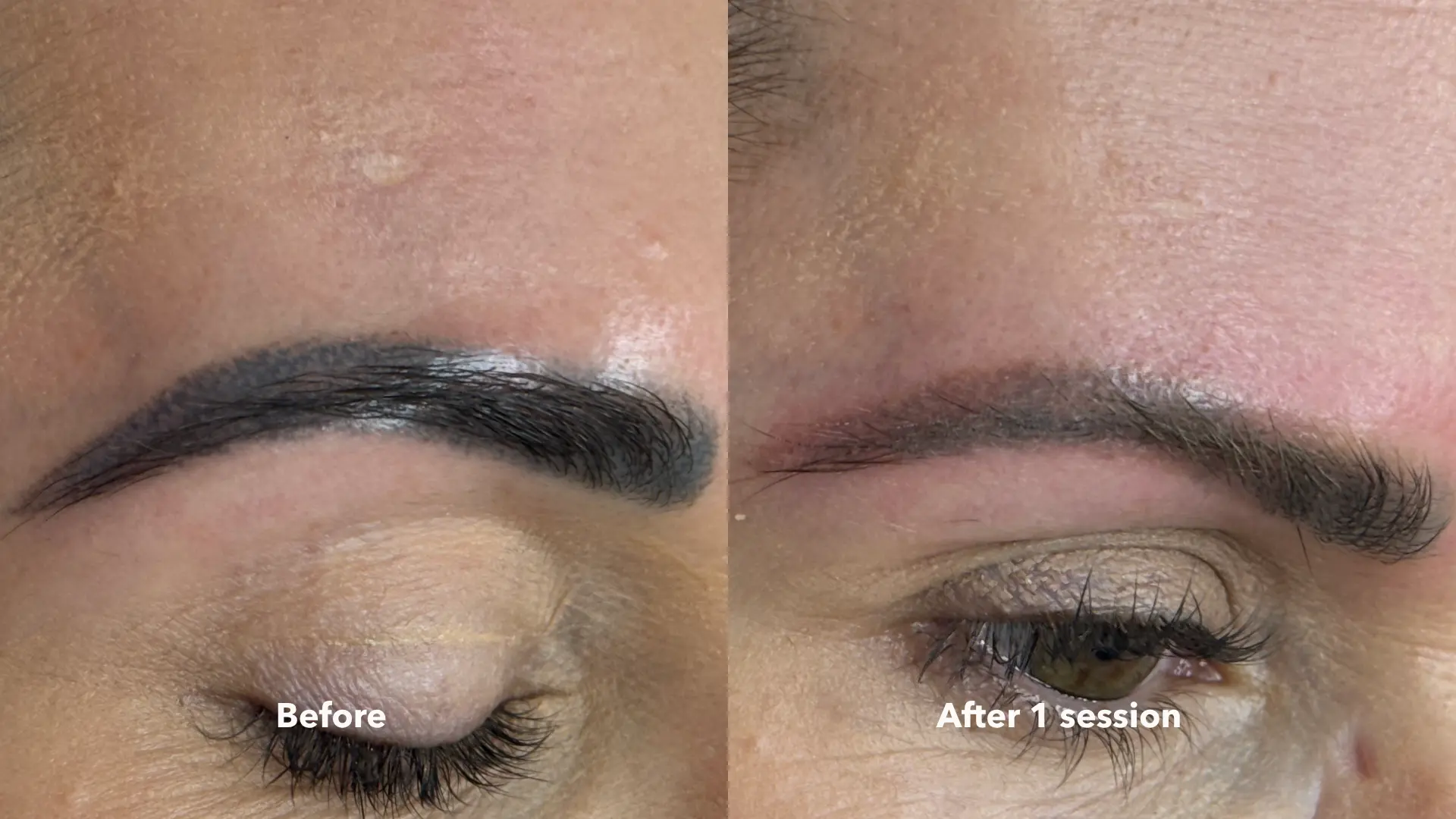Before and after Cosmetic Brow Removal at Get Glowing MedSpa — faded brow pigment after 1 session
