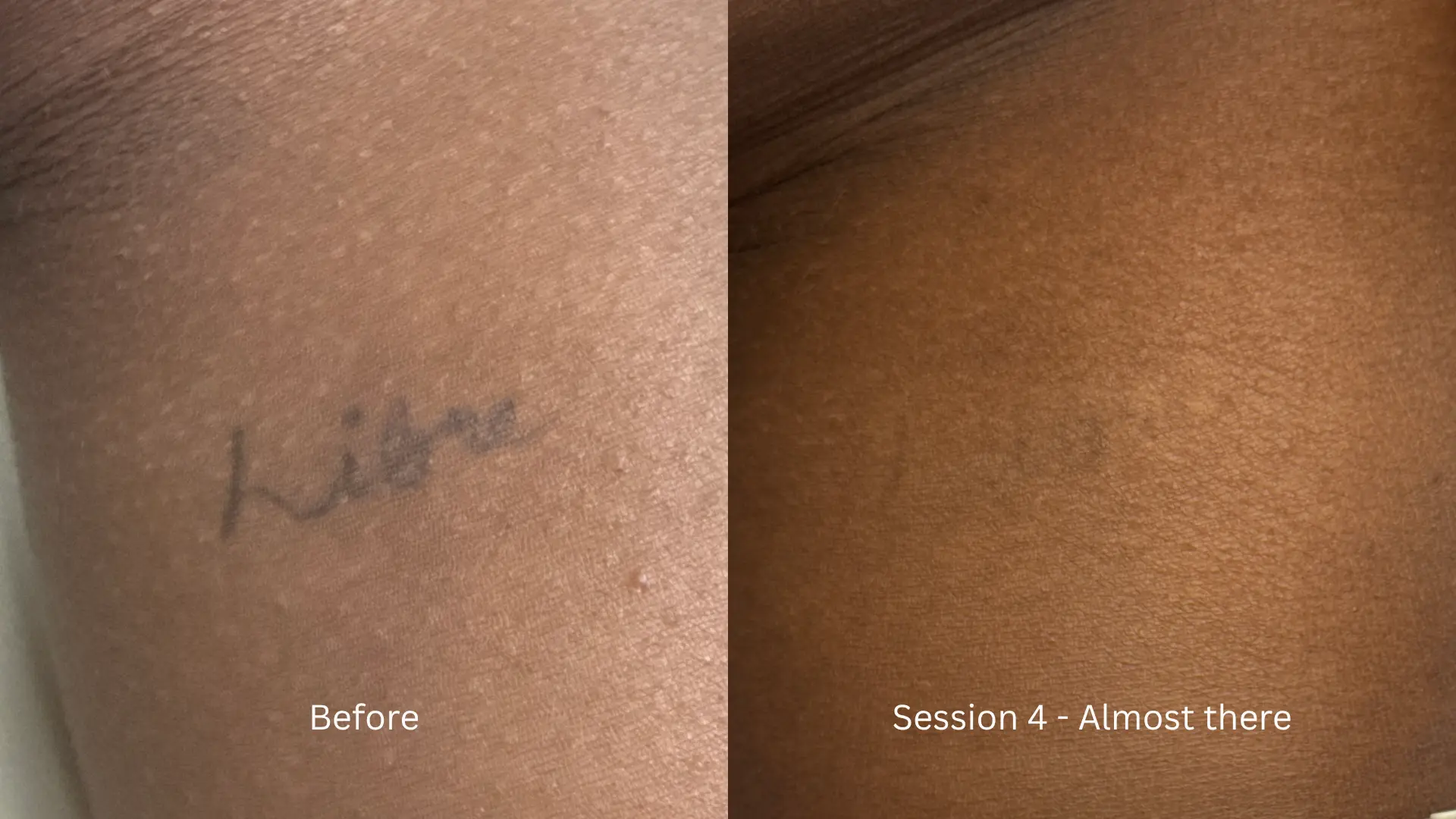 Before and after tattoo removal at Get Glowing MedSpa — small script tattoo nearly gone after 4 sessions