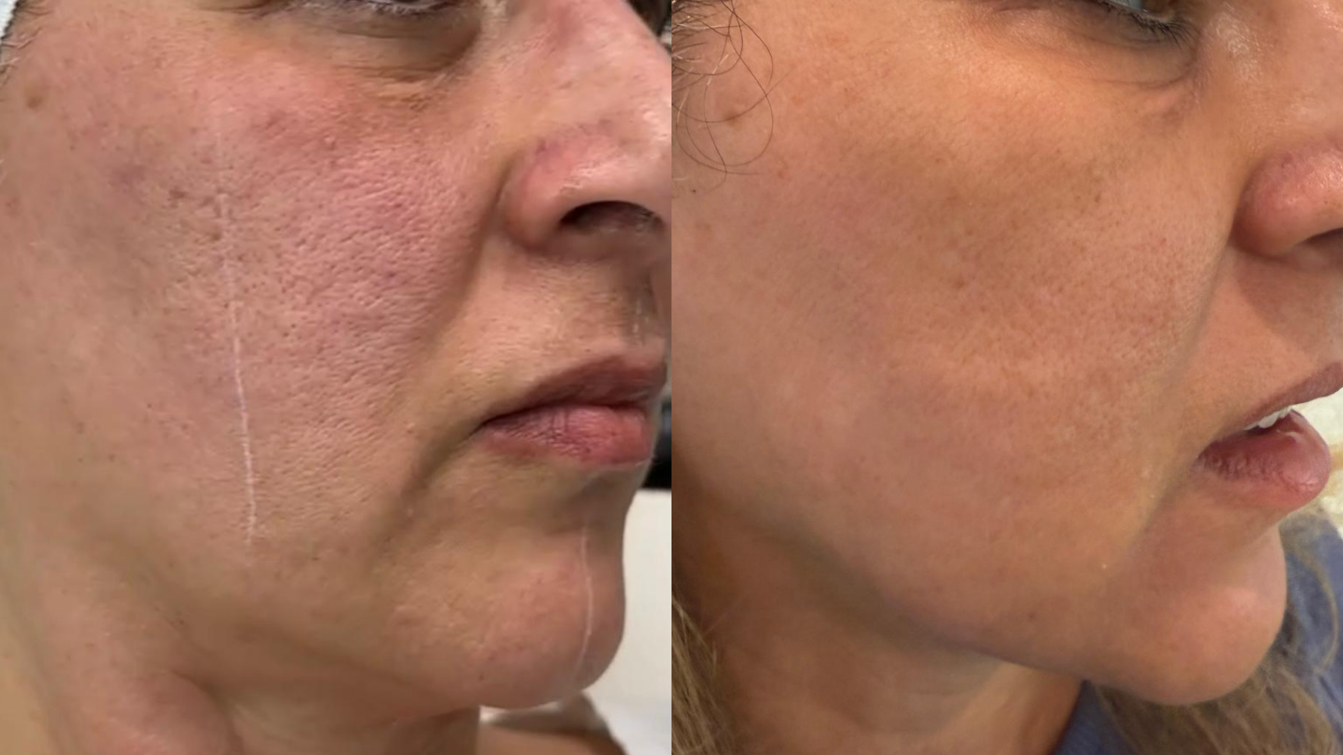 Before and after GlowUp Duo at Get Glowing MedSpa — clearer profile with reduced acne marks
