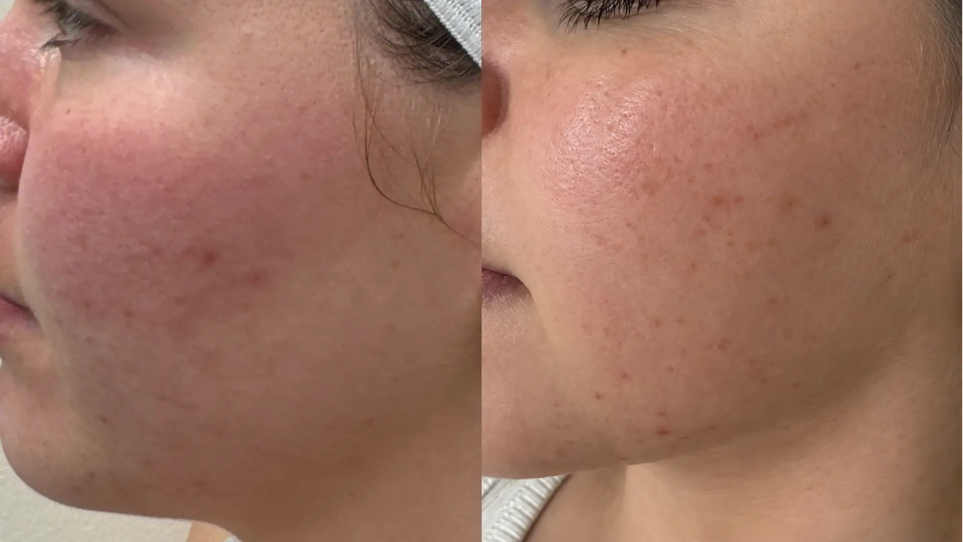 Before and after YAG Laser Facial at Get Glowing MedSpa — calmer redness and clearer cheek texture