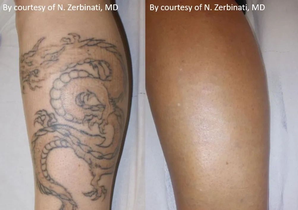 The Truth About Tattoo Removal