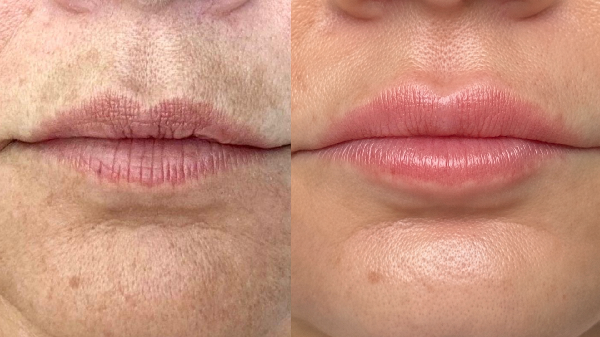 Before and after Melasma & Pigmentation treatment at Get Glowing MedSpa — smoother, revitalized skin around the mouth