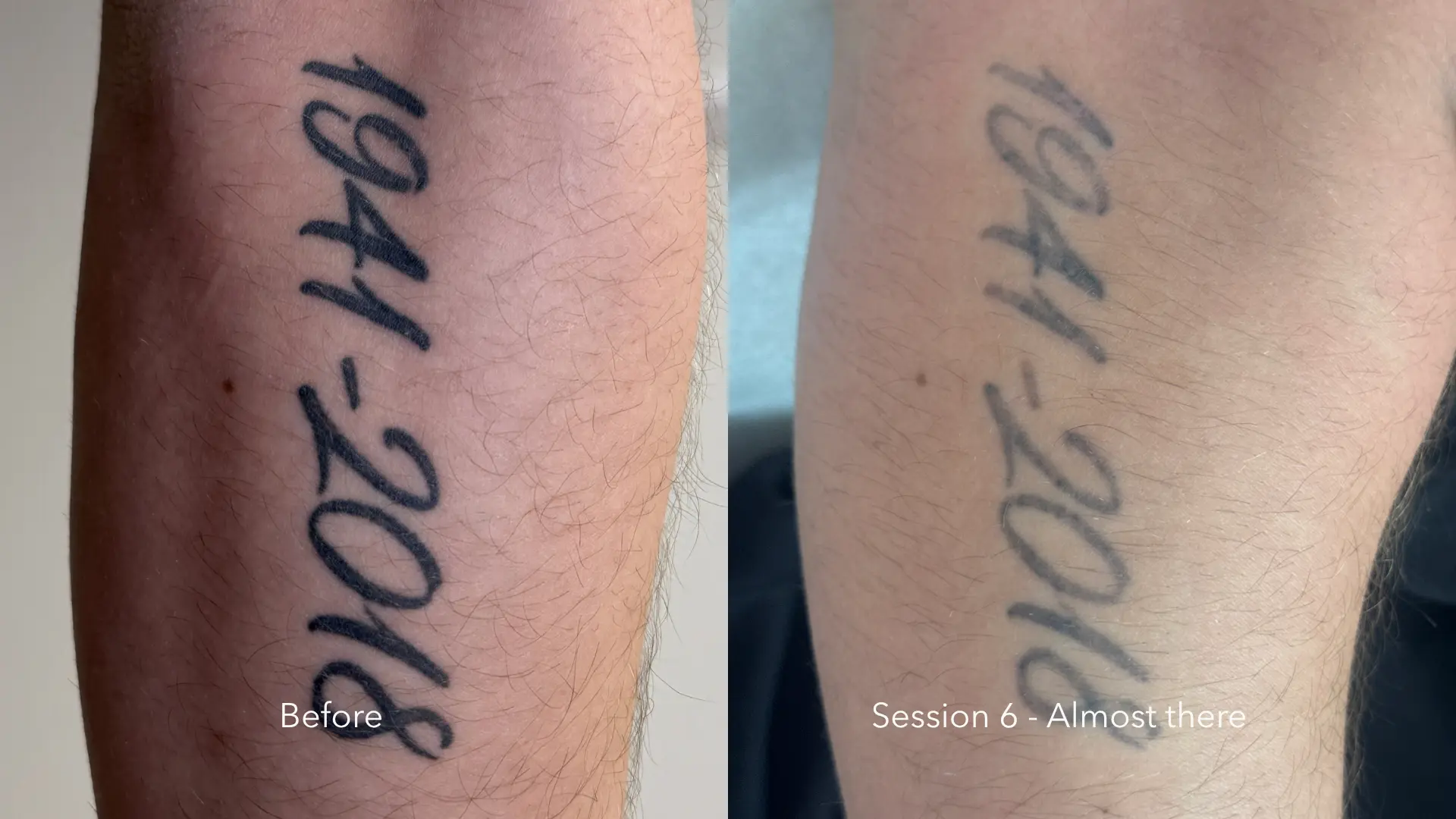 Before and after tattoo removal at Get Glowing MedSpa — script forearm tattoo significantly faded after 6 sessions