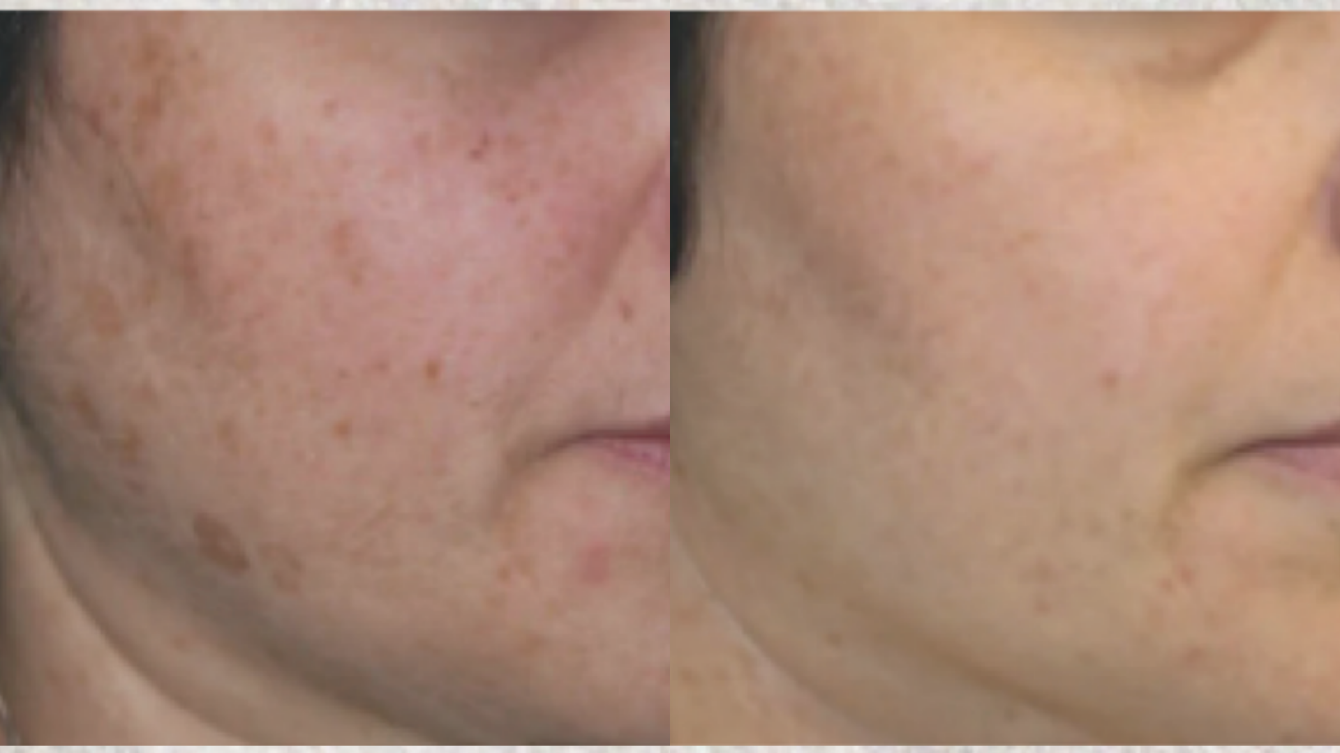 Before and after Melasma & Pigmentation treatment at Get Glowing MedSpa — reduced dark spots on the cheek and jawline