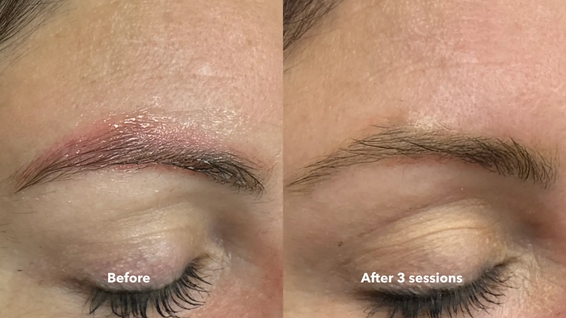 Before and after Cosmetic Brow Removal at Get Glowing MedSpa — significantly cleared brow pigment after 3 sessions