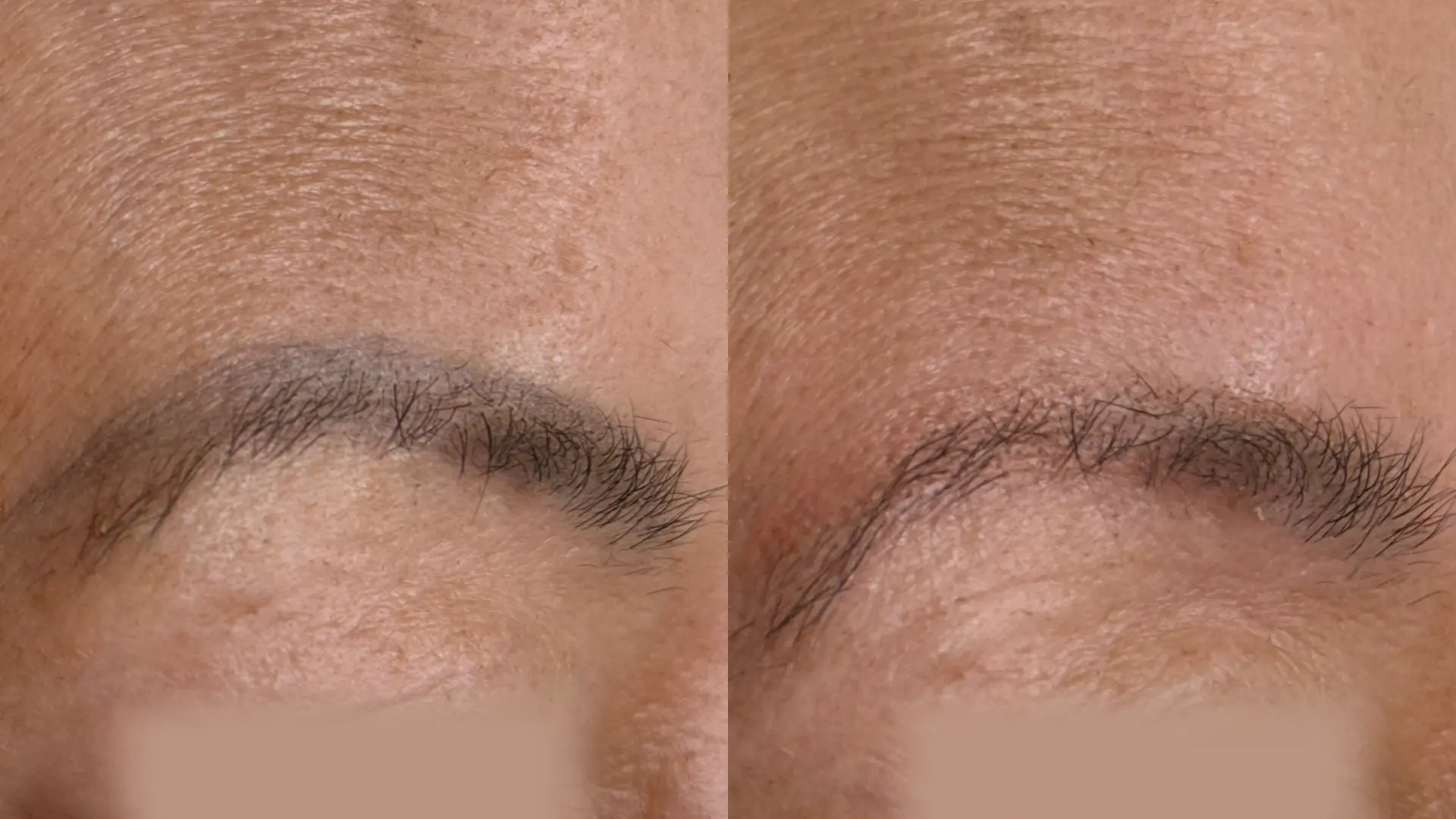 Before and after Cosmetic Brow Removal at Get Glowing MedSpa — brow pigment lifted for a lighter, more natural brow