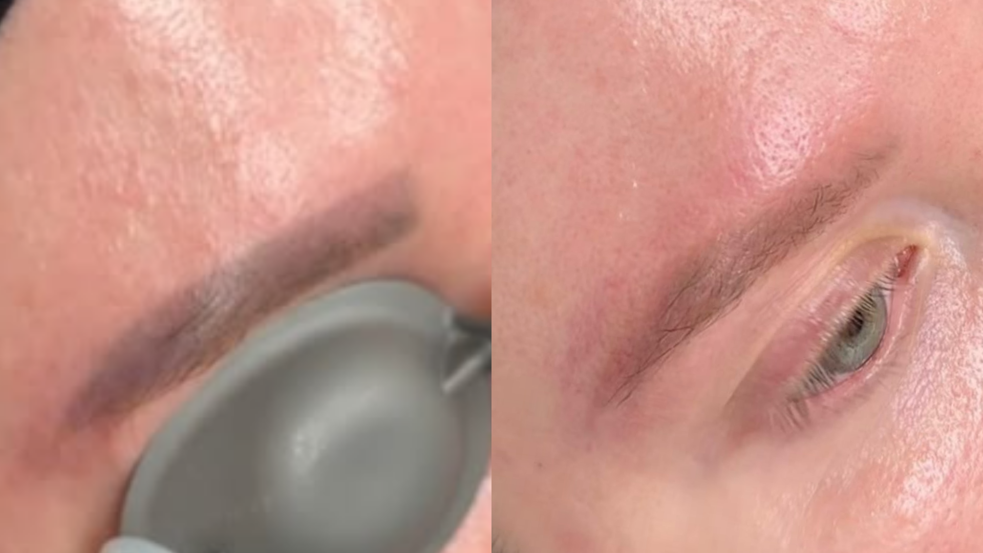 Before and after Cosmetic Brow Removal at Get Glowing MedSpa — laser session on faded brow pigment and the brow after treatment