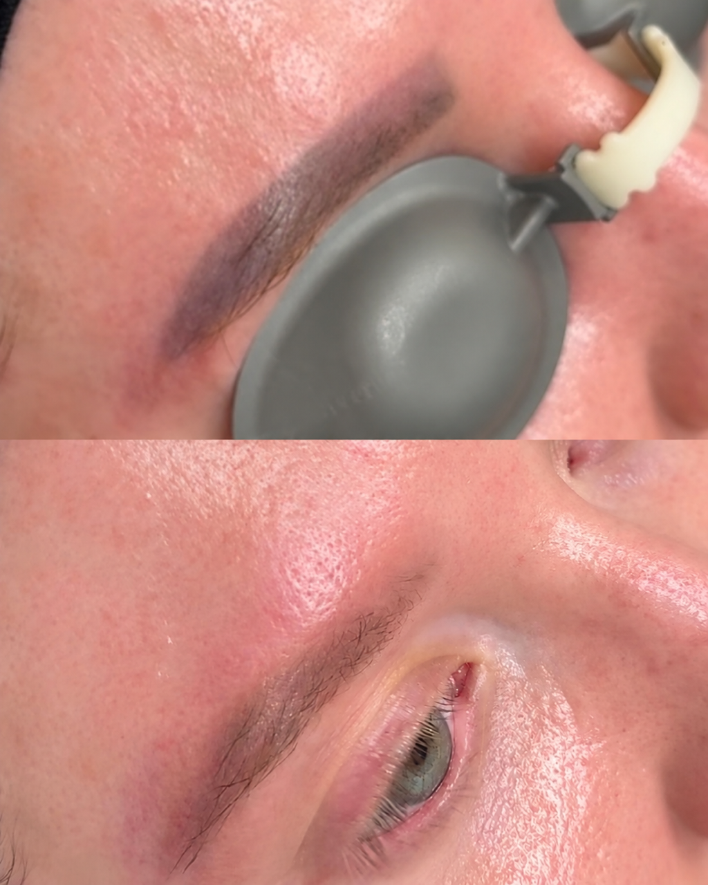 Before and after laser eyebrow tattoo removal at Get Glowing MedSpa — dark grayish-purple microblading pigment before treatment, and the brow with the pigment cleared and natural hairs remaining