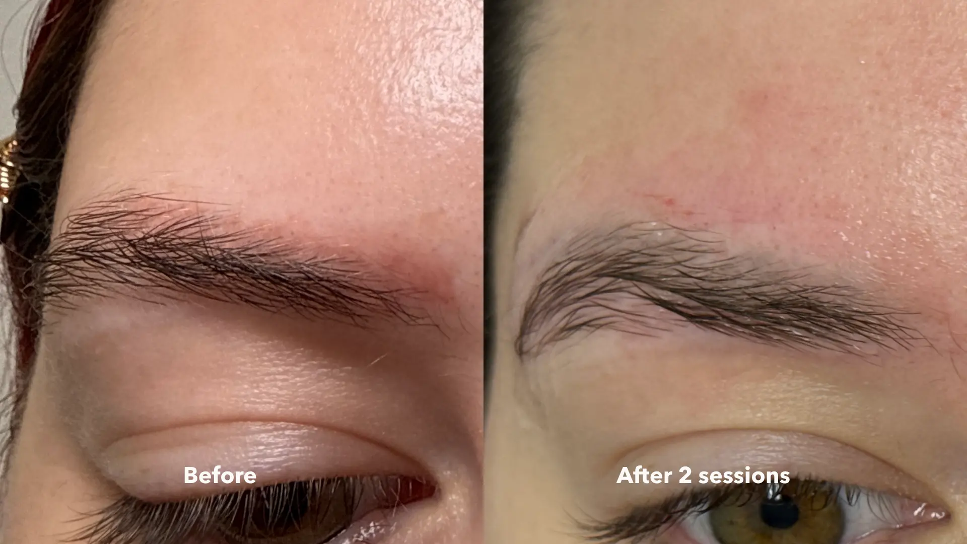 Before and after Cosmetic Brow Removal at Get Glowing MedSpa — lighter, more natural brow appearance after 2 sessions