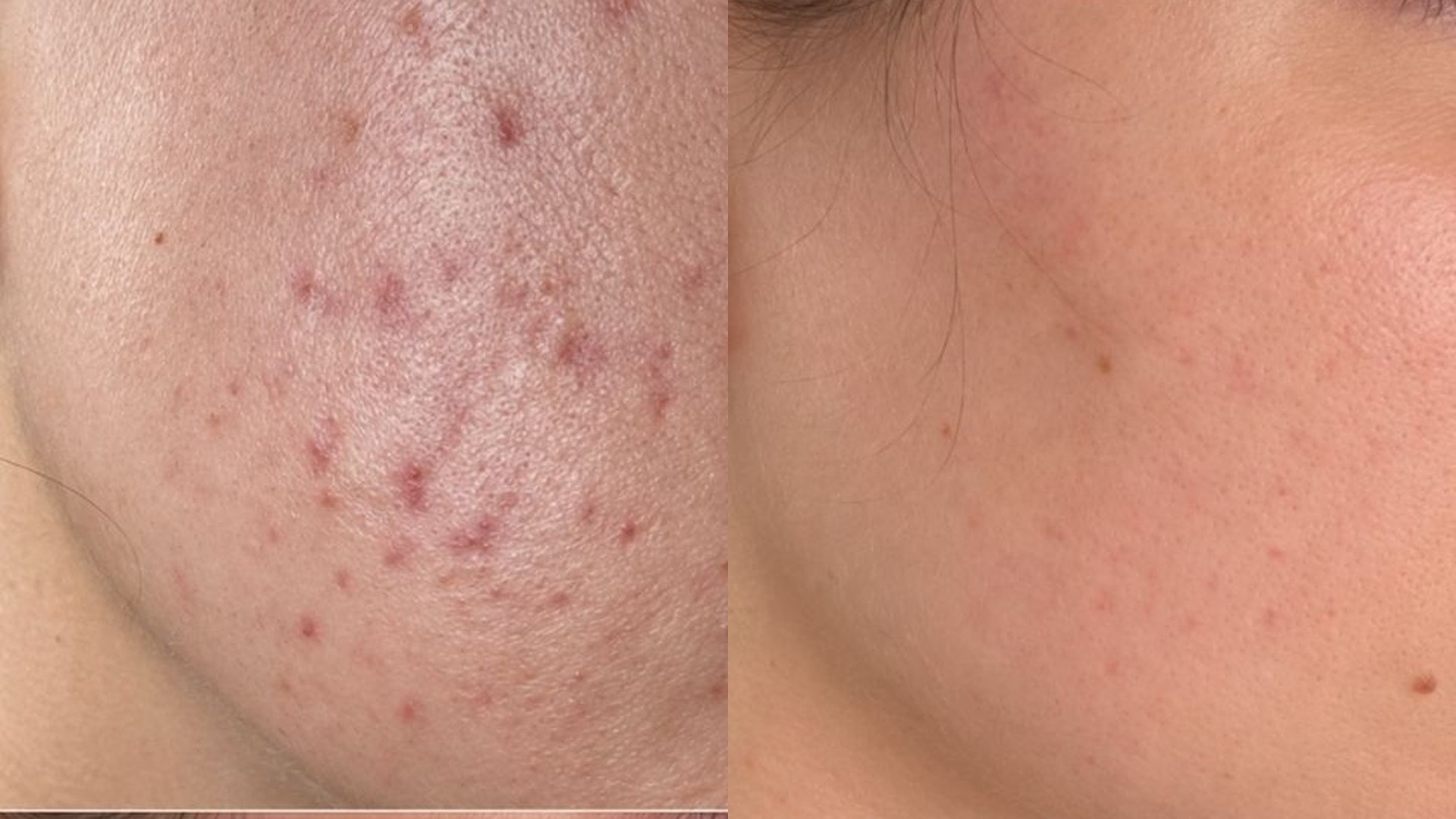 Before and after microneedling at Get Glowing MedSpa — clearer, smoother cheek texture